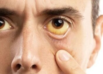 ¿Cómo se transmite la hepatitis y cuáles son los efectos más graves de esta infección?