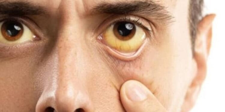 ¿Cómo se transmite la hepatitis y cuáles son los efectos más graves de esta infección?