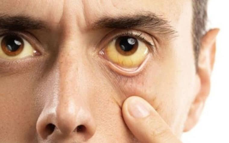 La OMS advirtió que la hepatitis podría matar a millones de personas en el año 2040