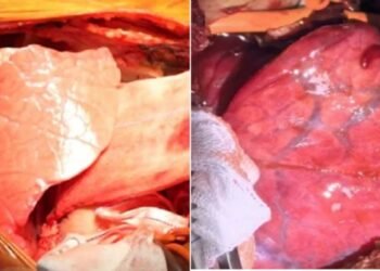 Médicos en China trasplantaron por primera vez un pulmón de cerdo a un hombre con muerte cerebral
