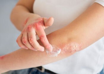Crearon un gel para tratar heridas en la piel que evita el desarrollo de cicatrices