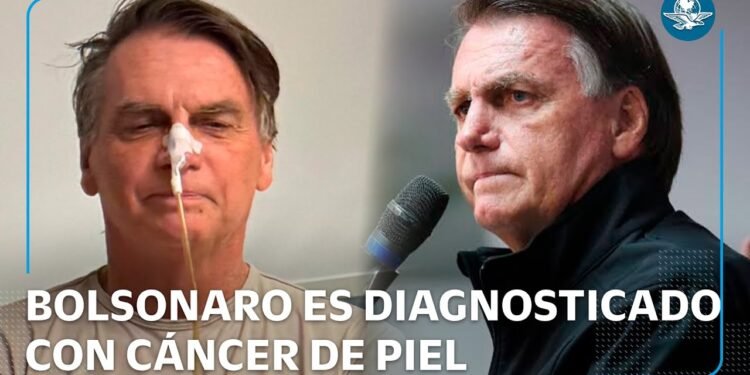 Diagnosticaron a Bolsonaro con cáncer de piel