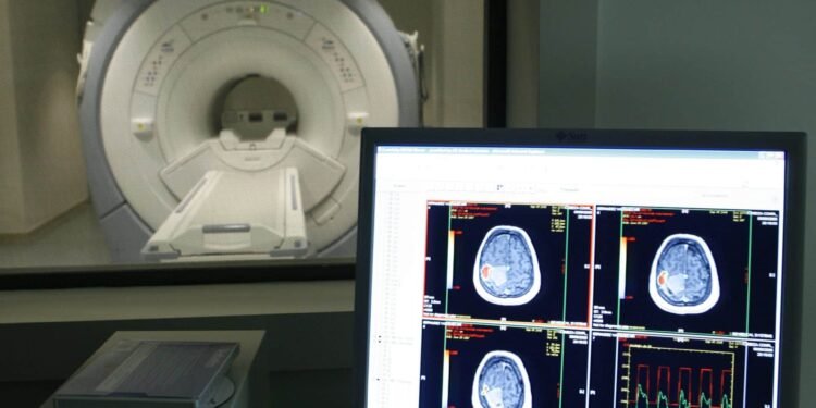 ¿Cómo reconocer los síntomas tempranos del alzhéimer?