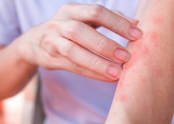 ¿Qué es la urticaria crónica, cómo se manifiesta y cuál es su tratamiento?