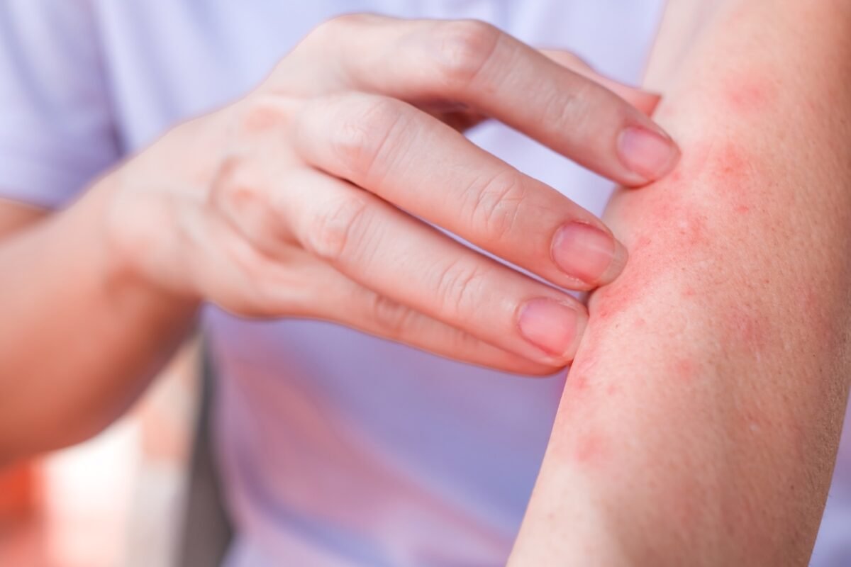 ¿Qué es la urticaria crónica, cómo se manifiesta y cuál es su tratamiento?