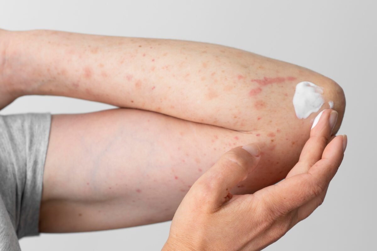 ¿Qué es la urticaria crónica, cómo se manifiesta y cuál es su tratamiento?