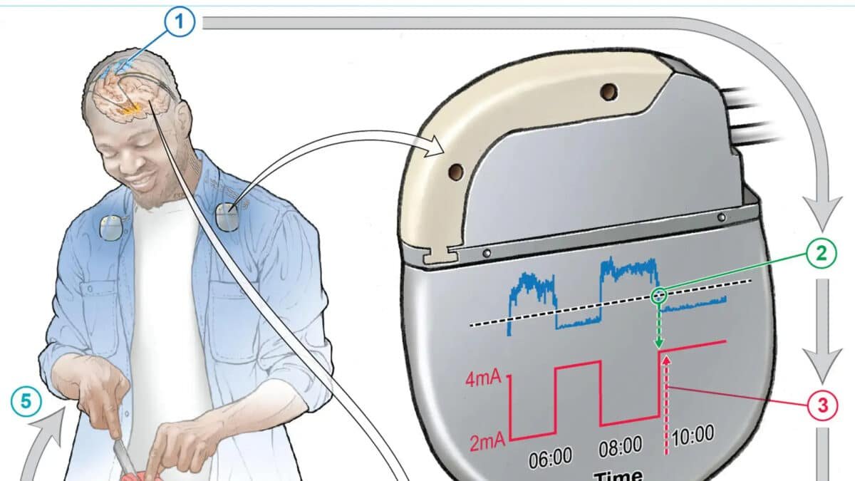 Implante inteligente podría mitigar los problemas de movilidad en pacientes con Parkinson
