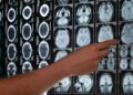 ¿Qué es un aneurisma cerebral y por qué se produce?