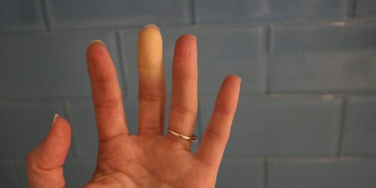 ¿Qué es el síndrome de Raynaud y por qué es más frecuente en las mujeres?