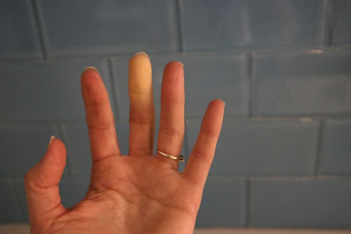 ¿Qué es el síndrome de Raynaud y por qué es más frecuente en las mujeres?