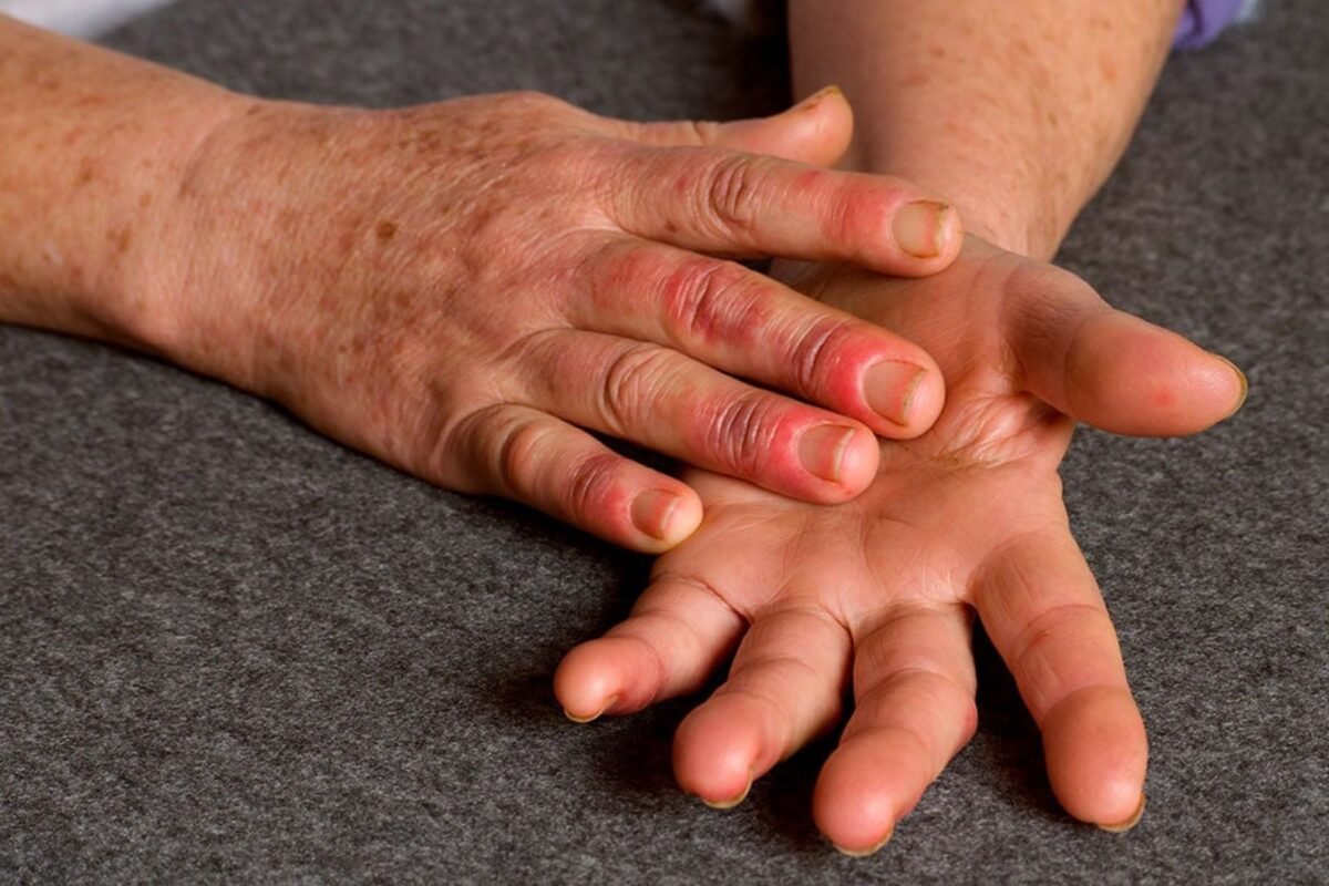 ¿Qué es el síndrome de Raynaud y por qué es más frecuente en las mujeres?