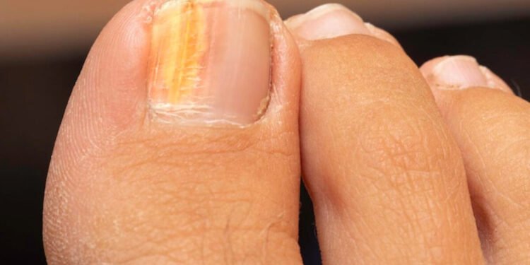 Onicomicosis: síntomas y tratamiento de la infección en las uñas por hongos